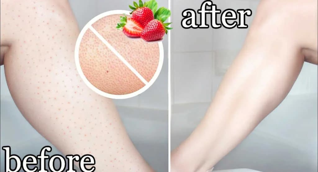 Strawberry Skin လိုမျိုး ခြေသလုံးမှာအစိလေးတွေဖြစ်နေတာကို ပျောက်အောင်လုပ်ပေးမယ့်နည်းလမ်းများ