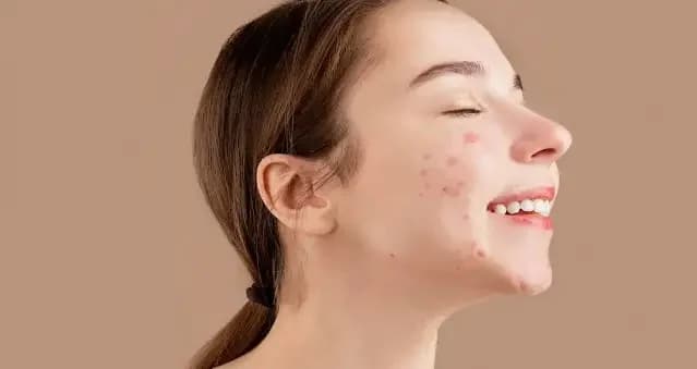 Acne-Prone Skin တွေအတွက် အကောင်းဆုံးအဖြစ်သတ်မှတ်ခံထားရတဲ့ Toner များ