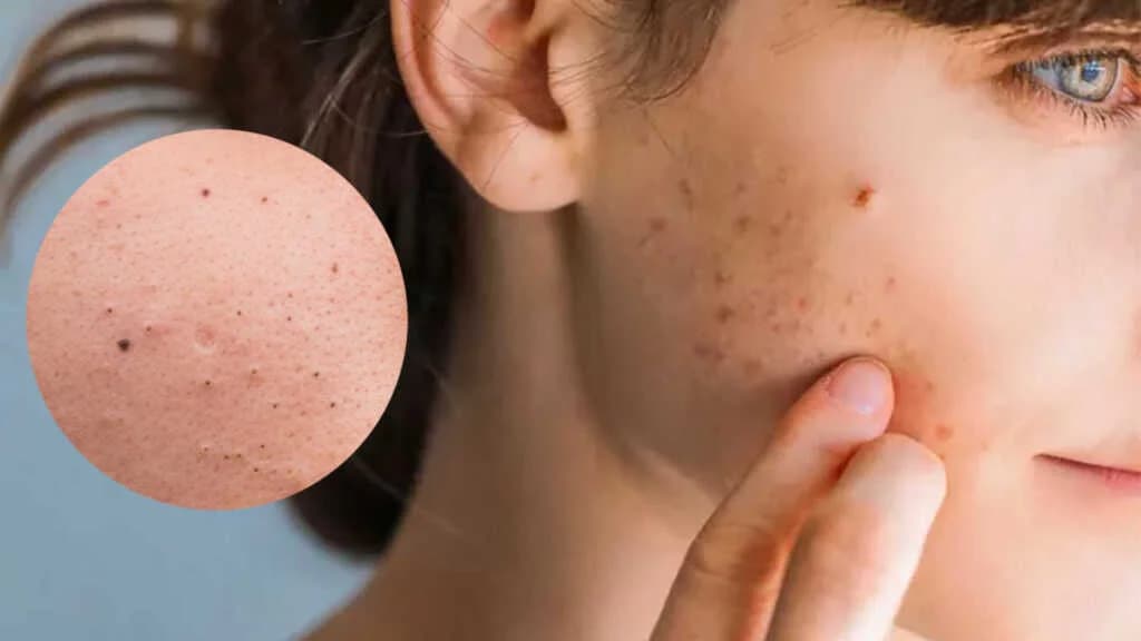 ပါးပြင်ပေါ်မှာပေါက်တဲ့ Blackheads တွေကို ဖယ်ရှားပေးမယ့် သဘာဝနည်းလမ်း ၄ မျိုး